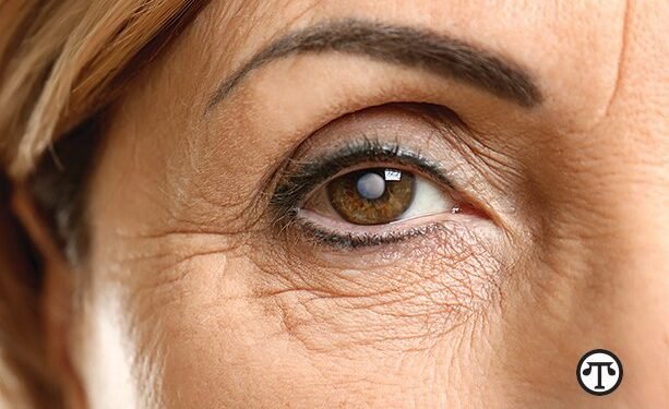 Lo que usted necesita saber sobre las cataratas